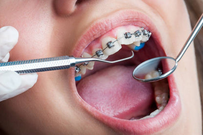 Niebieski Adheziv Ortodontyczny (1 strzykawka 2 ml) Ortho Flow Blue